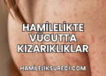 Hamilelikte Vücutta Kızarıklıklar