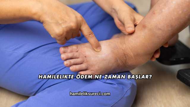 Hamilelikte Ödem Ne Zaman Başlar?